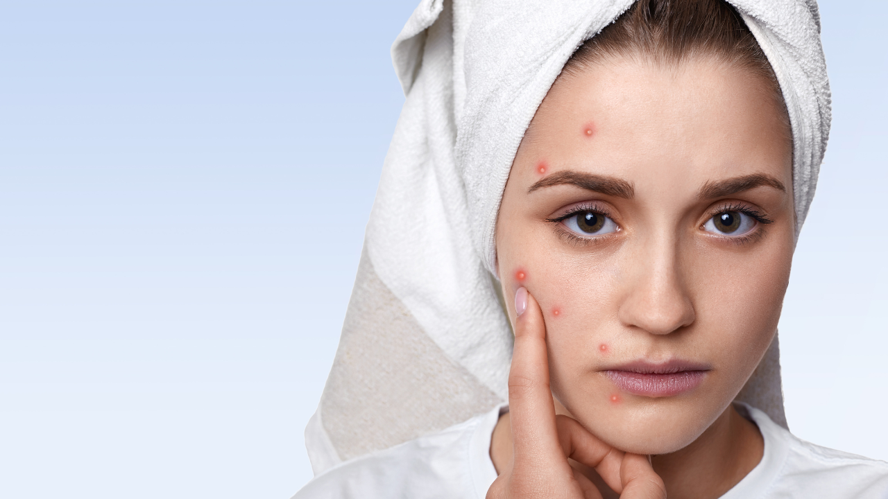Acne can be a sign that you need a detox